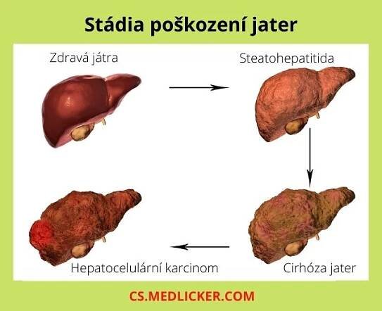 Hepatopatie je spojena s poškozením jater, které probíhá v několika stádiích - ztučnění (steatóza) jater, zánět jater (steatohepatitida), cirhóza jater a hepatocelulární karcinom