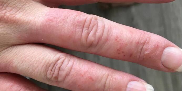 Ekzém lze řešit i bez pomocí kortikoidů. Jak přesně? – Žena v domácnosti