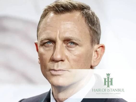 Daniel Craig Hair Transplant: What's the Real Story?