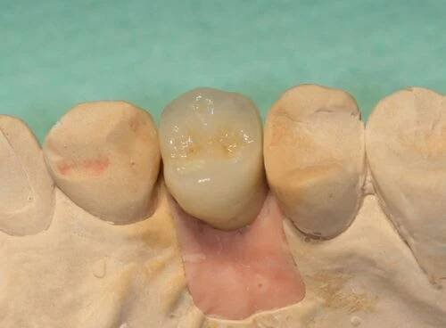Zubní implantát Brno _ premolár_korunka_3