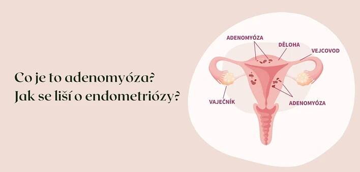 Co je to adenomyóza? Jak se liší o endometriózy?