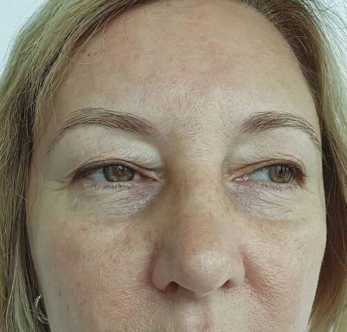 Filler before