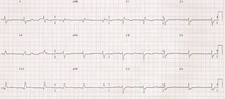 ECG bifascicular block (LPFB + RBBB)