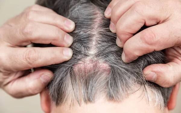 Psoriáza hlavy. Psoriáza hlavy. Psoriáza Vulgaris, psoriatické kožní onemocnění ve vlasech, kožní skvrny jsou typicky zarudlé, svědivé a šupinaté, makro s úzkým zaměřením. — Stock obrázek