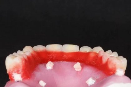 Zubní protéza s vnitřkem modelu — Stock obrázek