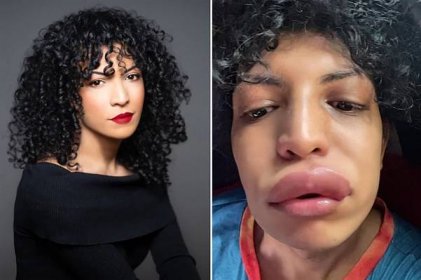This Woman’s Allergic Reaction Was Triggered By A Kiss