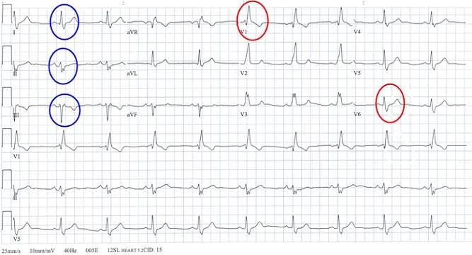 Bifascikulární blok - EKG | Medicína, nemoci, studium na 1. LF UK