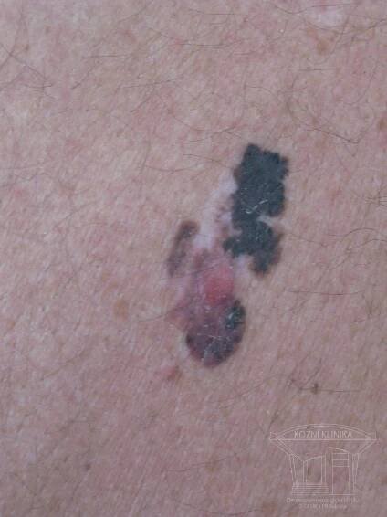 Fotografie kožních chorob | Česká Akademie dermatovenerologie
