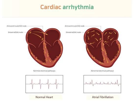 Heart Arrhythmia