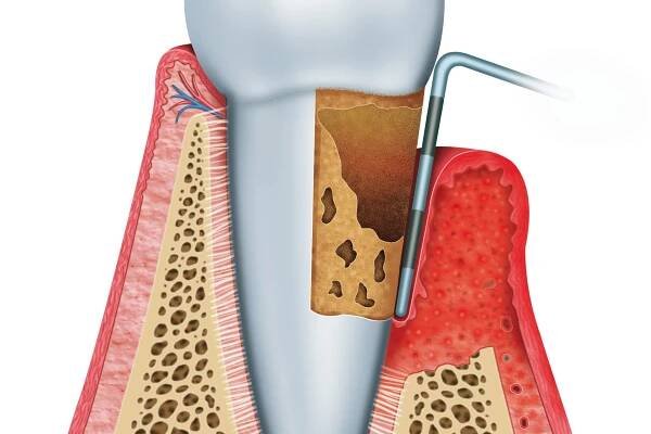 Infected Gum Pockets - Elegant Dental Care
