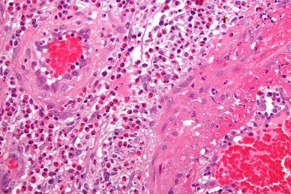 Category:Vasculitis - Wikimedia Commons