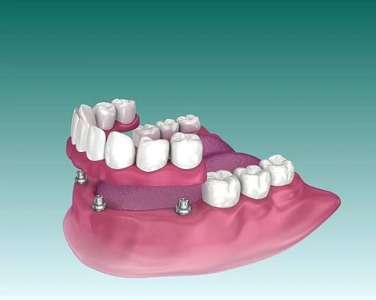 Vše o 4 zubní implantáty Turecko Antalya Grafické