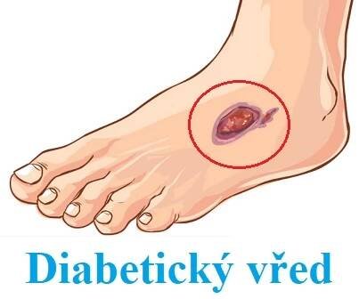 Syndrom diabetické nohy a vředy z cukrovky - co je to - příznaky, příčiny a léčba