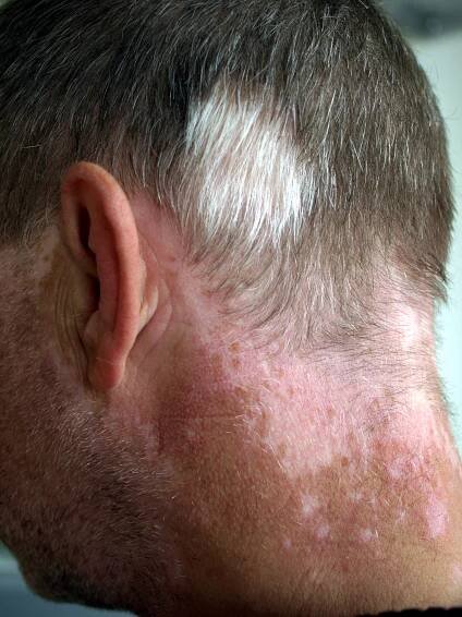 Vitiligo – WikiSkripta