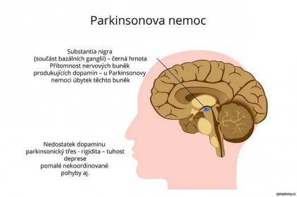 Parkinsonova choroba - příznaky a projevy | Zdraví a léčba