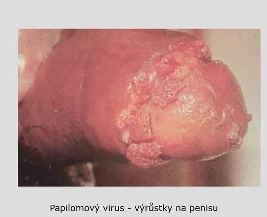 PPT - Pohlavní choroby PowerPoint Presentation, free download - ID:4380095