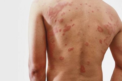 alergie svědění kůže