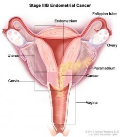 Stage IIIB endometrial cancer shown in a cross-section drawing of the uterus, cervix, fallopian tubes, ovaries, and vagina. Cancer is shown in the endometrium of the uterus, the parametrium, the cervix, and the vagina.