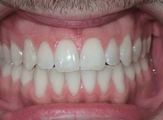 Smile Gallery - Zaytoun Orthodontics