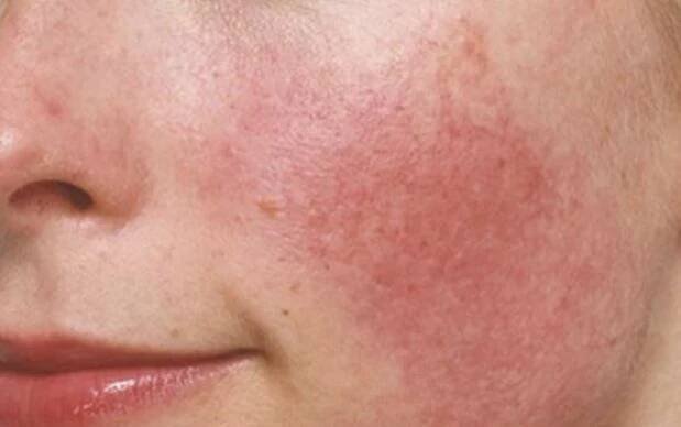 Rosacea (růžovka) a kuperóza | Eucerin