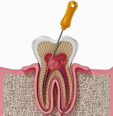 Root Canal - South San Francisco Dentist