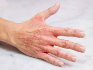 Onemocnění, která mohou signalizovat oteklé prsty. Nepřehlížejte tento příznak - Zdravestravovani.eu