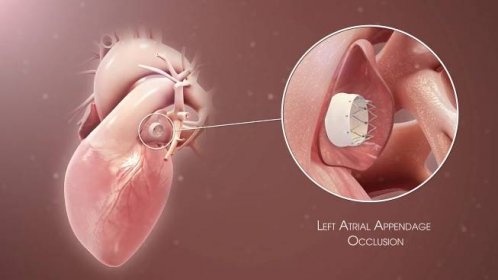 Left atrial appendage occlusion