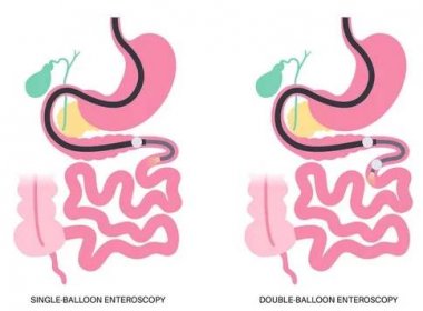 Dvojitá a jednoduchá enteroskopie balónu minimálně invazivní procedura. Vizualizace tenkého střeva. Biopsie, polyp odstranění, krvácivá terapie nebo umístění stentu v gastrointestinálním traktu .poster. — Ilustrace