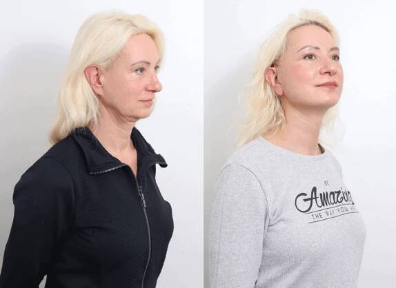 Lifting obličeje QuickLift - Arte Clinic