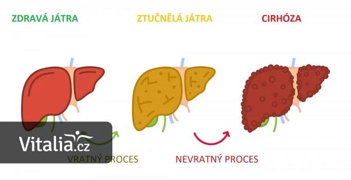 Ztučnělá játra má až třetina lidí, hrozí jim cirhóza. Orgán se přitom může uzdravit - Vitalia.cz