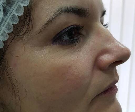 Nechirurgická modelace nosu – rhinoplastika