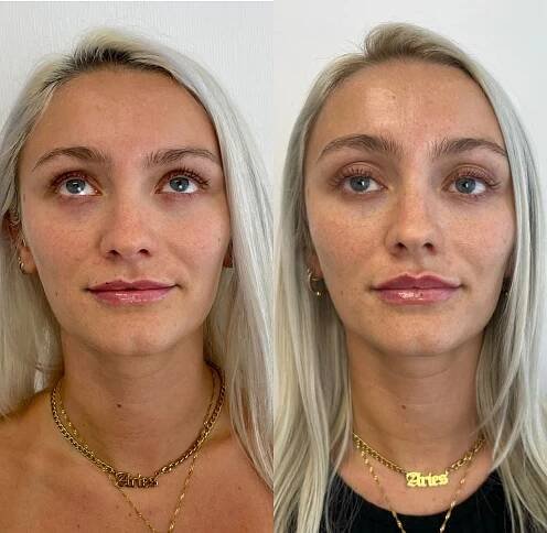 Injectables Lip Filler in Boston and Southborough MA 