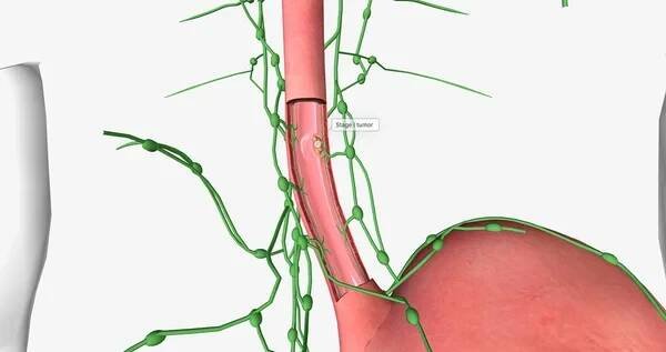 In stage I esophageal cancer, the tumor has spread through some of the layers of the esophageal wall. 3D rendering — Stock obrázek