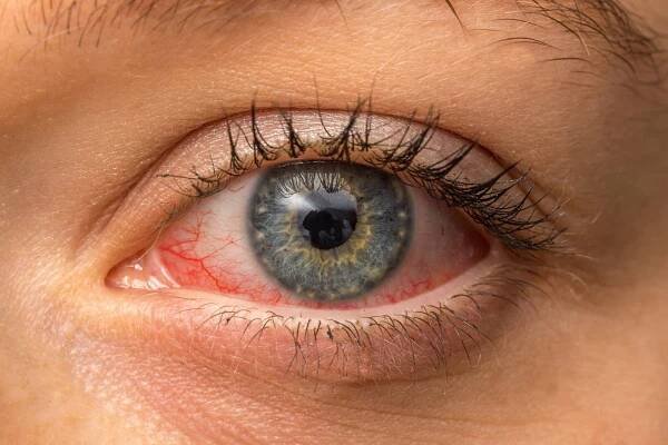 Add "red eyes" as an early symptom of Cov2 - drjonritz.com