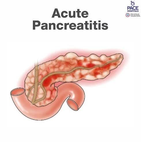 Acute Pancreatitis Treatment in Hyderabad