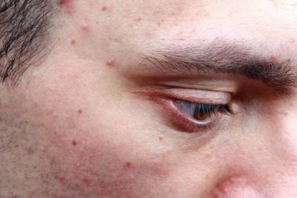 Dermatologické onemocnění akné pupínky na tváři člověka — Stock obrázek
