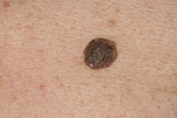 909 Archives - Skin Cancer 909