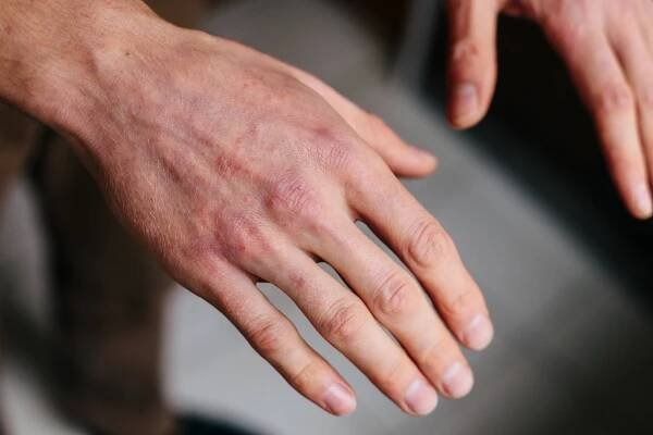 Psoriatická kůže. Detailní záběr vyrážky a šupinatění na kůži pacienta. Koncept léčby chronických onemocnění. Dermatologické problémy. Tvrdá, nadržená a popraskaná kůže v mužských rukou. Suchá kůže. — Stock obrázek
