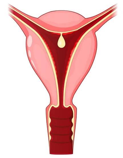 Děložní polyp. Lidská děloha s endotriálním polypem, který je k děloze připevněn podlouhlou pedikulou. Vektorový plakát. — Ilustrace