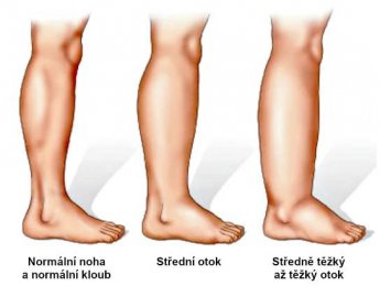 Oteklé a bolavé nohy
