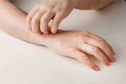 Mužské ruce škrábou svědící červené tečky na kůži. Alergická reakce ze špatné stravy, vedlejší účinek užívání antibiotik nebo léků. Kožní onemocnění — Stock obrázek