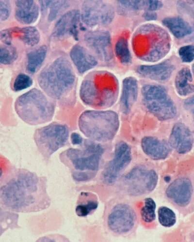Dostarlimab při msi-h/dmmr kolorektálním karcinomu
