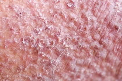 Atopická dermatitida (AD), také známý jako atopický ekzém, je typ zánětu kůže (dermatitida). — Stock obrázek