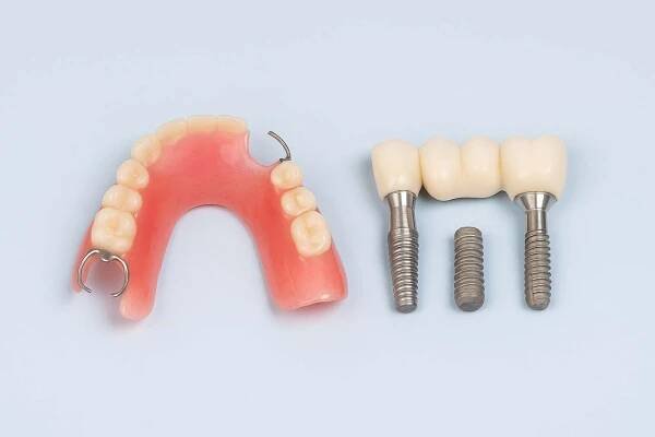 Zubní implantáty nebo částečná zubní protéza: Kdy zvolit které řešení? - Zubní klinika Lavin