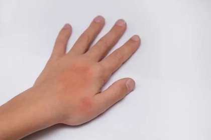 Červené skvrny na kůži rukou dítě pokryté krém. Příčinou je zimní chladné a větrné podmínky. Světle šedé pozadí. — Stock obrázek