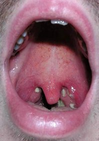 Infekce dutiny ústní a horních dýchacích cest