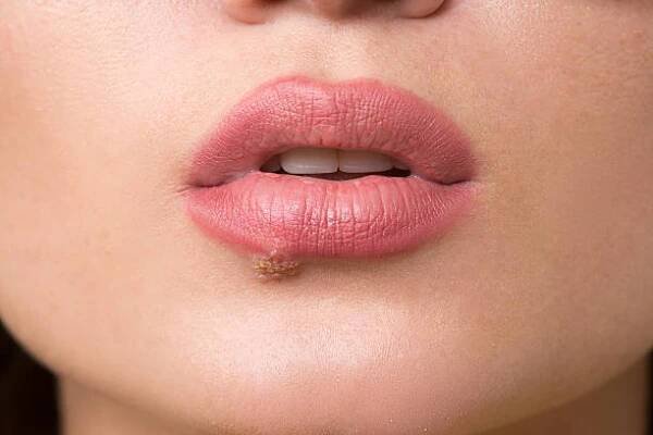 Krásné rty infikovaných virem herpes — Stock obrázek