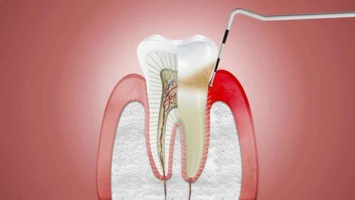 Zub moudrosti: příznaky, příčiny a léčba