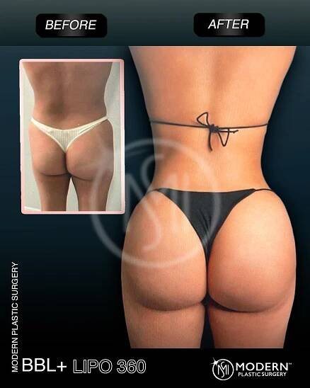 brazilian-butt-lift