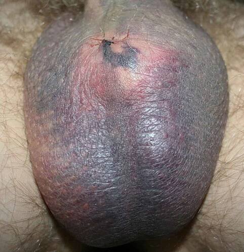 Pictures of hematoma-related bruising and swelling after vasectomy